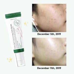 Access Way Korean Dark Spot Serum