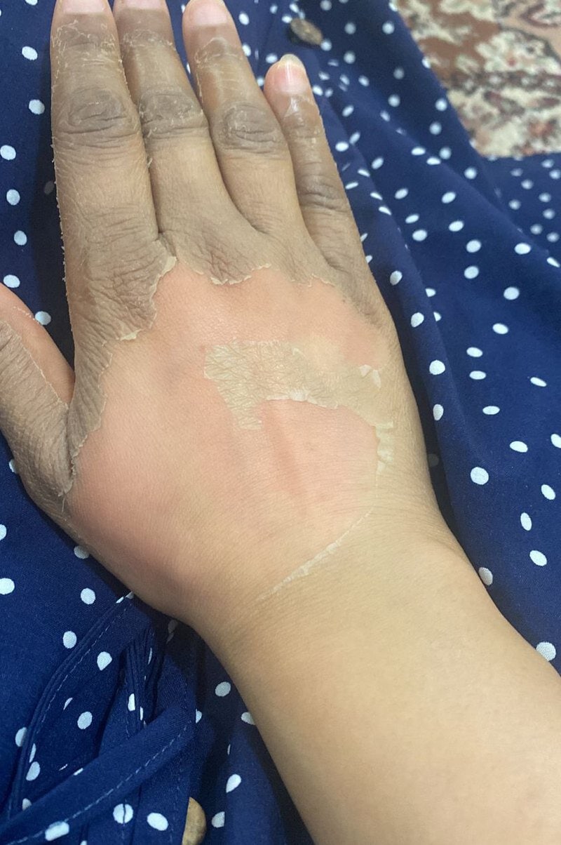 نتيجة فروتي بيل على اليدين