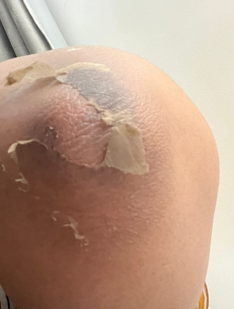 نتيجة فروتي بيل على الركبة